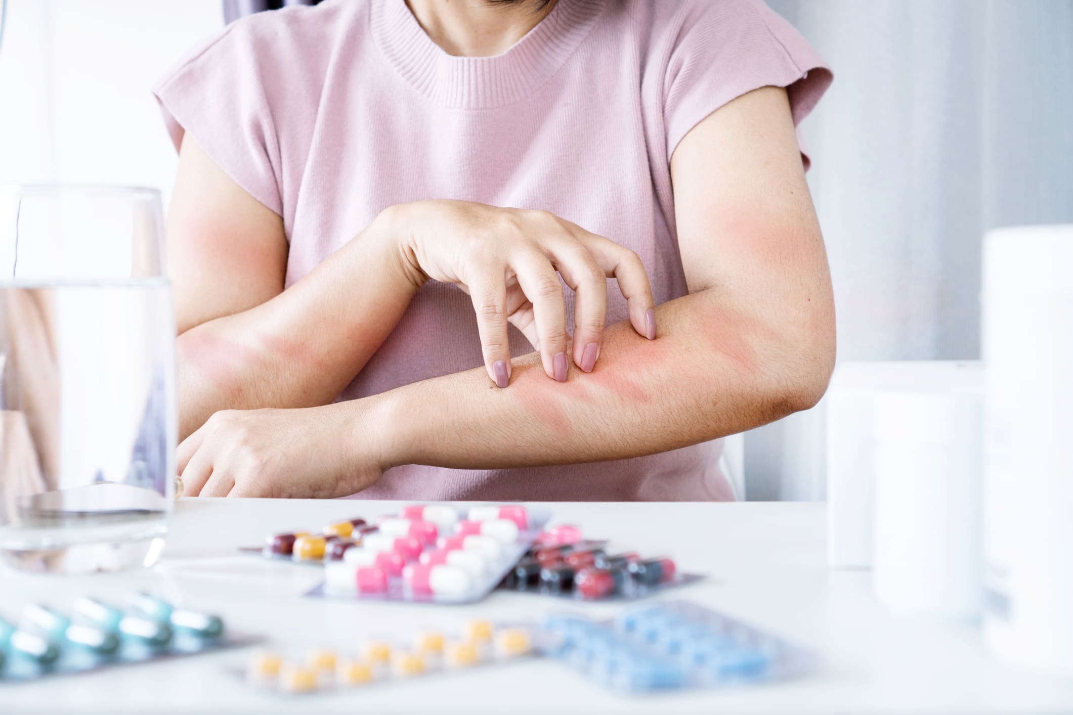 Woman’s Allergic Reaction to Medication: Scratching Itchy Skin on Arm from Side Effects